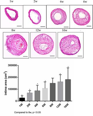 Analysis of MicroRNAs Associated With Carotid Atherosclerotic Plaque Rupture With Thrombosis